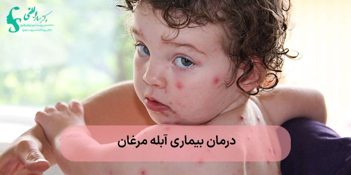 درمان آبله مرغان