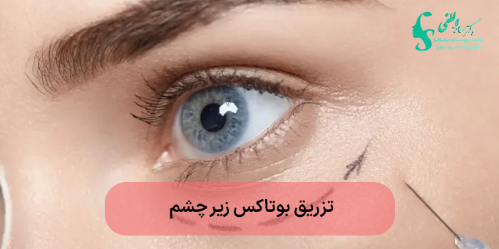 تزریق بوتاکس زیر چشم