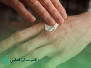 درمان قطعی اگزما در تهران