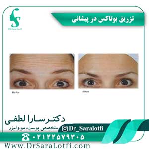 نمونه کار تزریق بوتاکس دکتر سارا لطفی