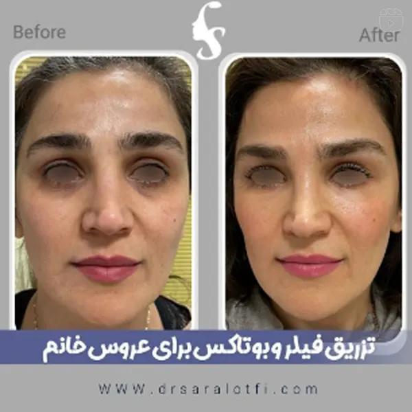 نمونه کار تزریق بوتاکس دکتر سارا لطفی