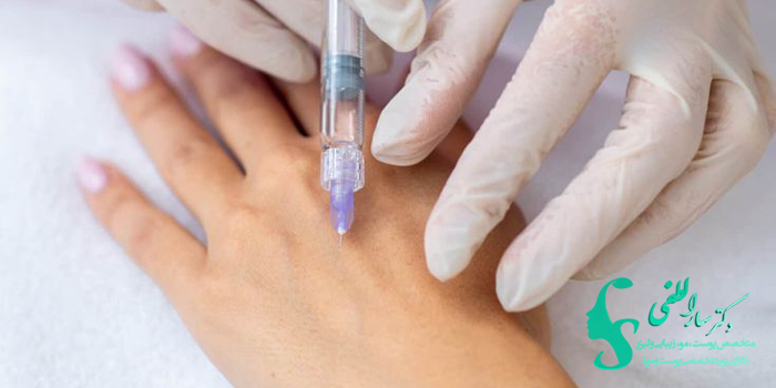 ماندگاری تزریق چربی به پشت دست چقدر است؟