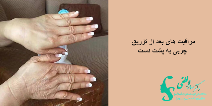 مراقبت های بعد از تزریق چربی به پشت دست