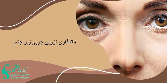 ماندگاری تزریق چربی زیر چشم