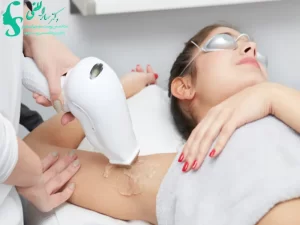 لیزر موهای زائد