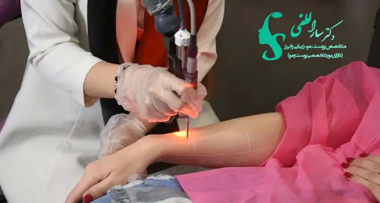 مراقبت های بعد از اولین جلسه لیزر موهای زائد
