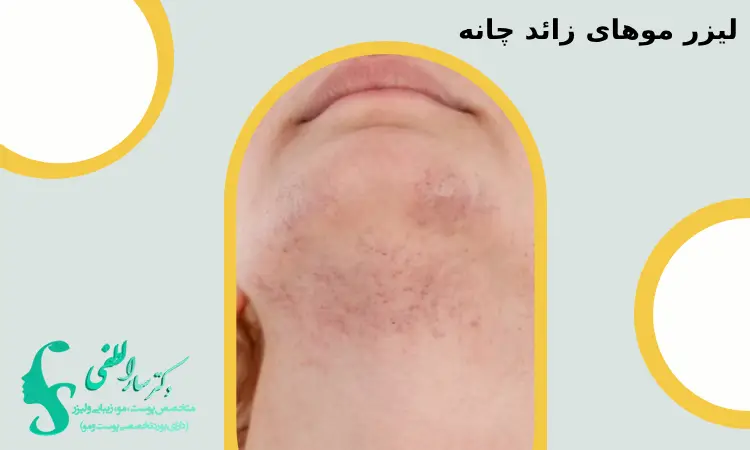 آیا لیزر موهای زائد چانه با عوارض همراه است؟