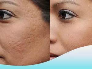 عوارض سابسیژن