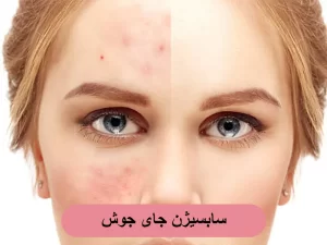 سابسیژن جای جوش