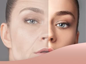 ماندگاری تزریق چربی