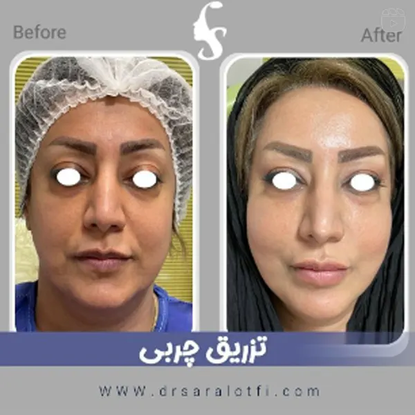 نمونه کار تزریق چربی دکتر سارا لطفی