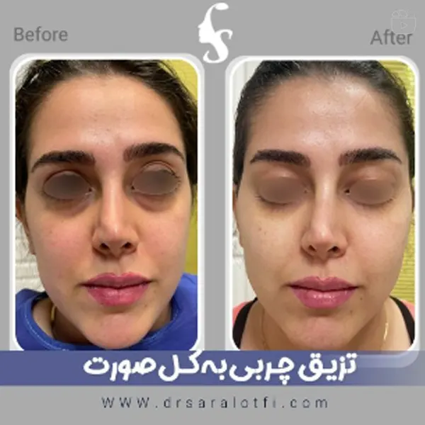 نمونه کار تزریق چربی دکتر سارا لطفی