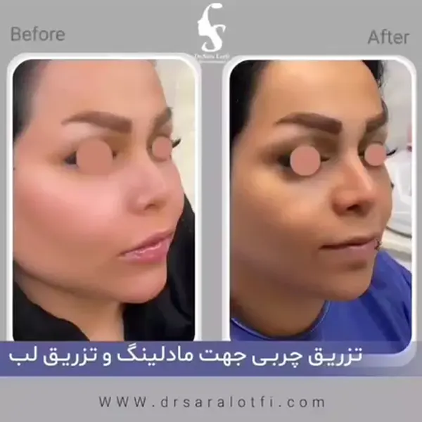 نمونه کار تزریق چربی دکتر سارا لطفی