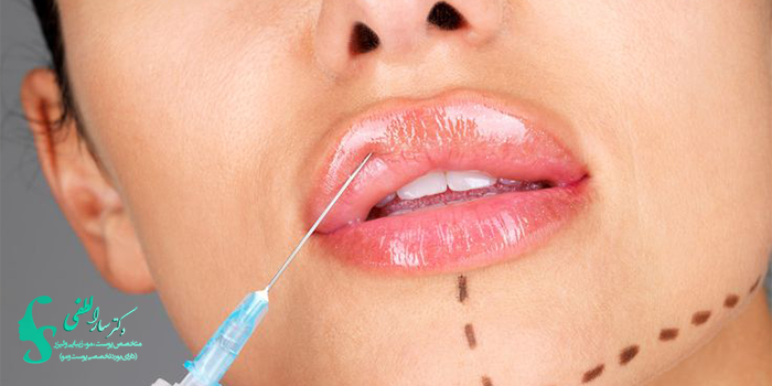 تزریق چربی به لب