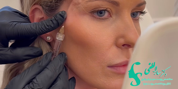 ماندگاری فیلر شقیقه چقدر است؟