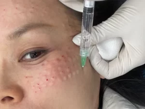 عوارض مزوتراپی