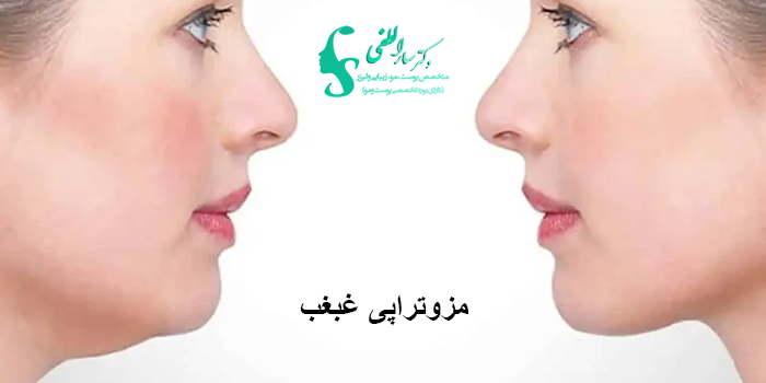 مزوتراپی غبغب