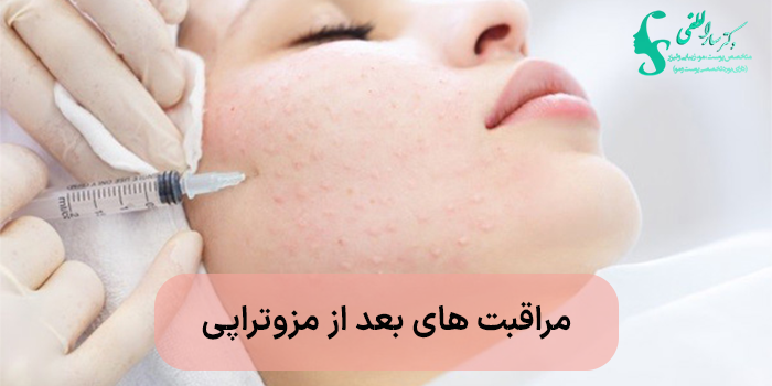 مراقبت های بعد از مزوتراپی