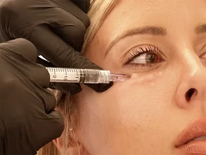 مزوتراپی زیر چشم