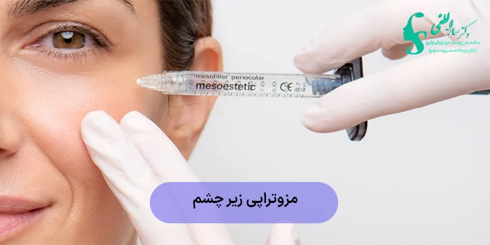 مزوتراپی زیر چشم