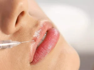 تزریق بوتاکس لب