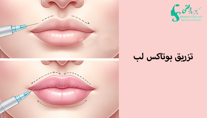 تزریق بوتاکس لب