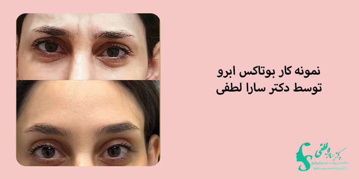 بوتاکس ابرو برای چه افرادی مناسب است؟