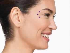 تزریق بوتاکس خطوط پنجه کلاغی