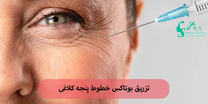 تزریق بوتاکس خطوط پنجه کلاغی