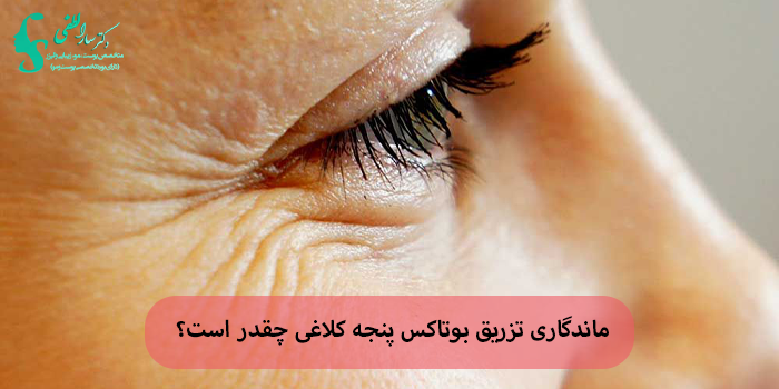 ماندگاری تزریق بوتاکس پنجه کلاغی چقدر است؟