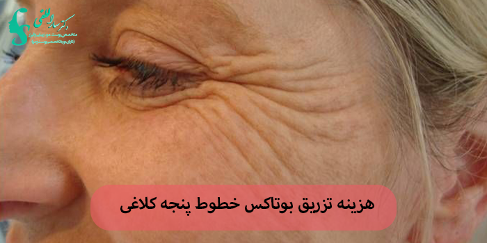 هزینه تزریق بوتاکس خطوط پنجه کلاغی