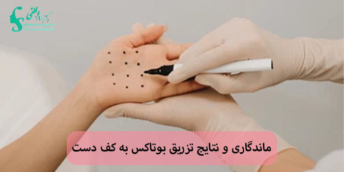 ماندگاری و نتایج تزریق بوتاکس به کف دست